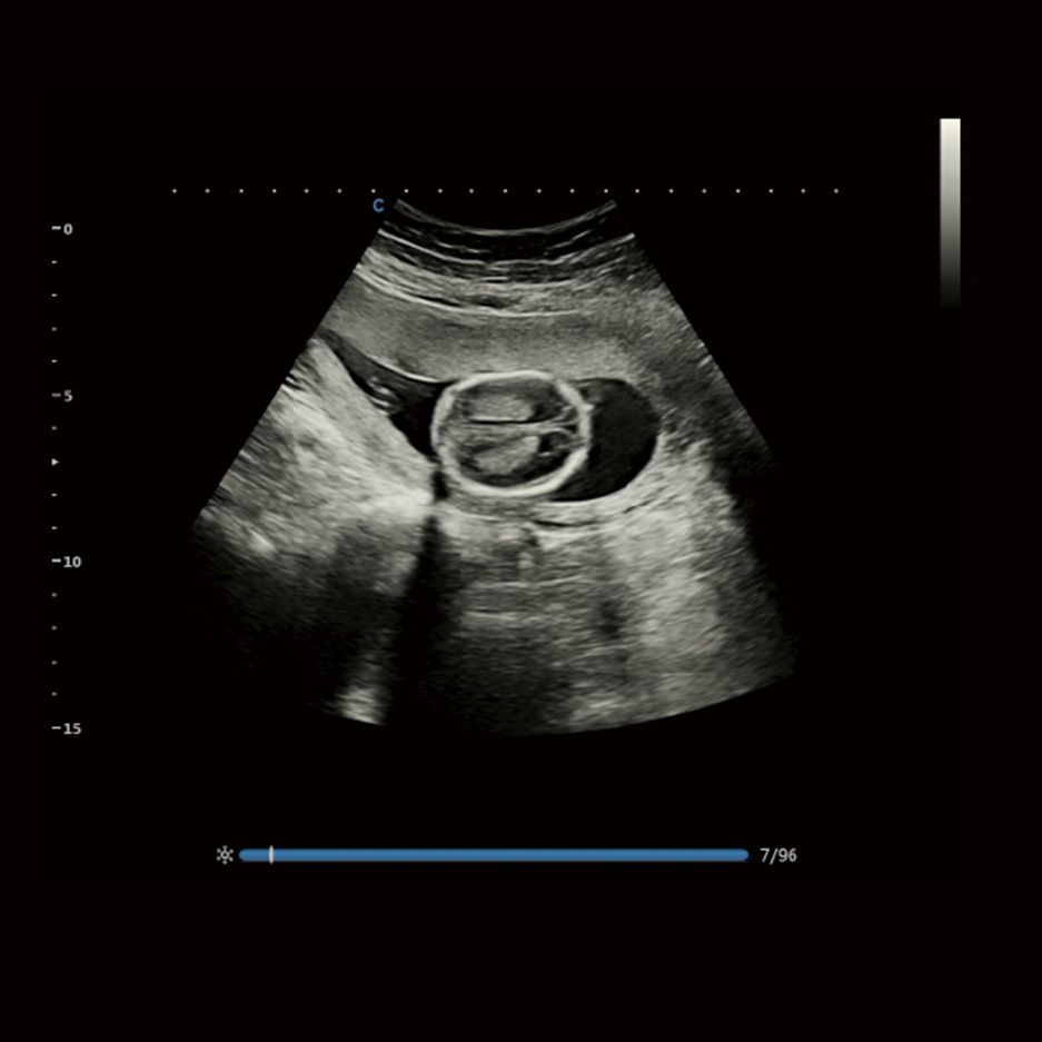 XBit fetus bmode